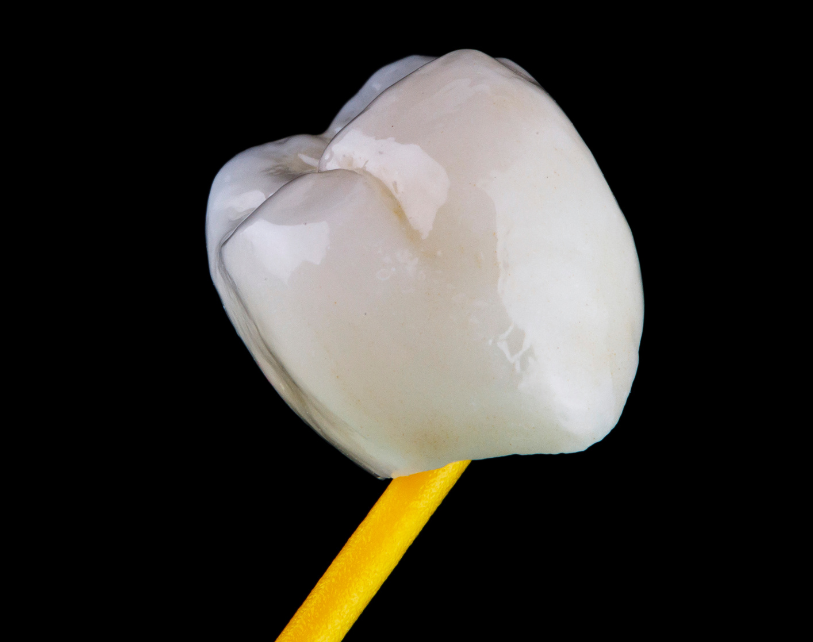 coroana ceramica emax smile wise
