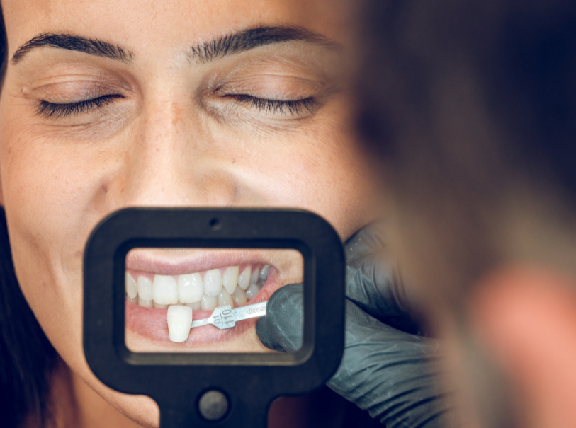 fatete dentare smile wise 2
