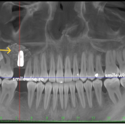 Vreau implanturi dentare, dar dentistul mi-a spus ca nu am os suficient. Ce să fac?